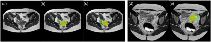 Comprehensive Pelvic MRI Dataset for Deep Learning in Endometriosis Organ Segmentation