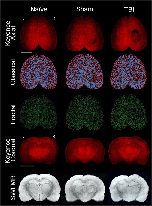 The Role of Bubbles in Brain Injury