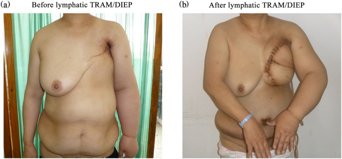 A retrospective study of lymphatic transverse rectus abdominis  myocutaneous/deep inferior epigastric perforator flaps for breast cancer  treatment-induced upper-limb lymphoedema | Scientific Reports