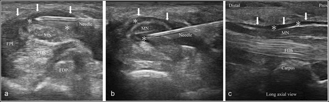 Best Ultrasound Articles For Ectopic In The Emergency Room Best Ultrasound Articles For Ectopic In The Emergency Room