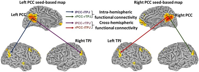 Posterior Cingulate Cross Hemispheric Functional Connectivity Predicts The Level Of Consciousness In Traumatic Brain Injury Scientific Reports Posterior Cingulate Cross Hemispheric Functional Connectivity Predicts The Level Of Consciousness In Traumatic Brain Injury Scientific Reports