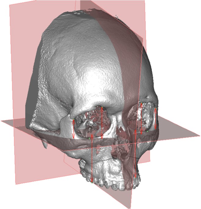 selection of a horizontal reference plane in 3d evaluation thank you reference