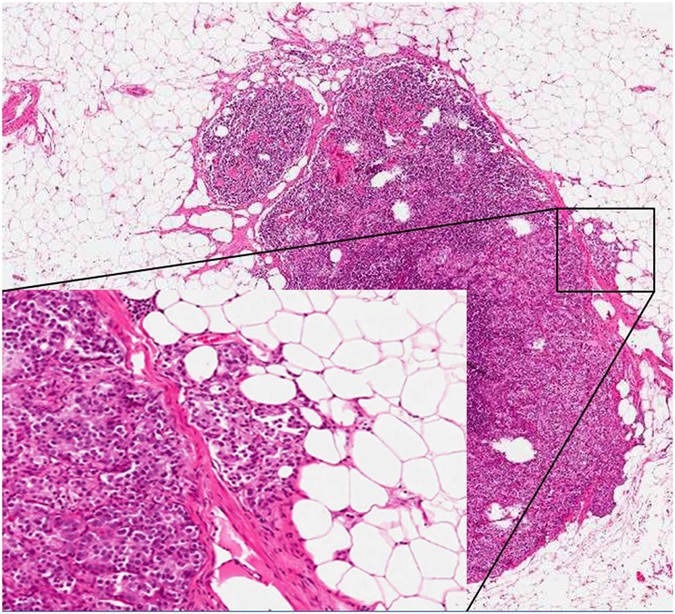 Extranodal extension of lymph node metastasis influences recurrence in prostate cancer: a systematic review and meta-analysis
