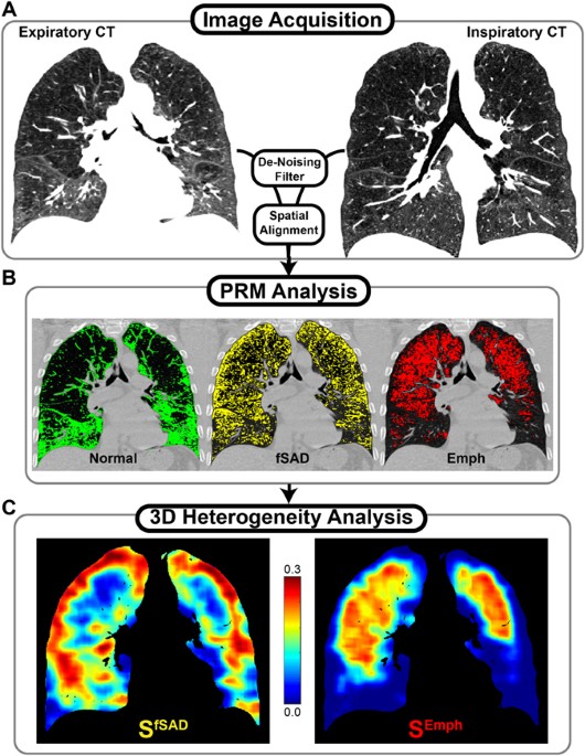 Ct-based local distribution metric improves characterization of copd