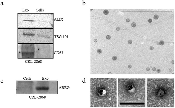 Amphiregulin contained in NSCLC-exosomes induces osteoclast differentiation through the activation of EGFR pathway