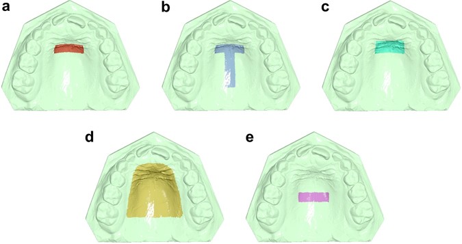 Assessment Of Different Techniques For 3d Superimposition Of Serial Digital Maxillary Dental Casts On Palatal Structures Scientific Reports