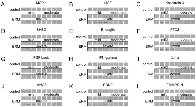 Cytokine Array Determined Expression Of Non Classical Vasoactive Cytokines In Epiretinal Membrane ERM Patients Who Had Mild 250 349 Um Cytokine Array Determined Expression Of Non Classical Vasoactive Cytokines In Epiretinal Membrane ERM Patients Who Had Mild 250 349 Um