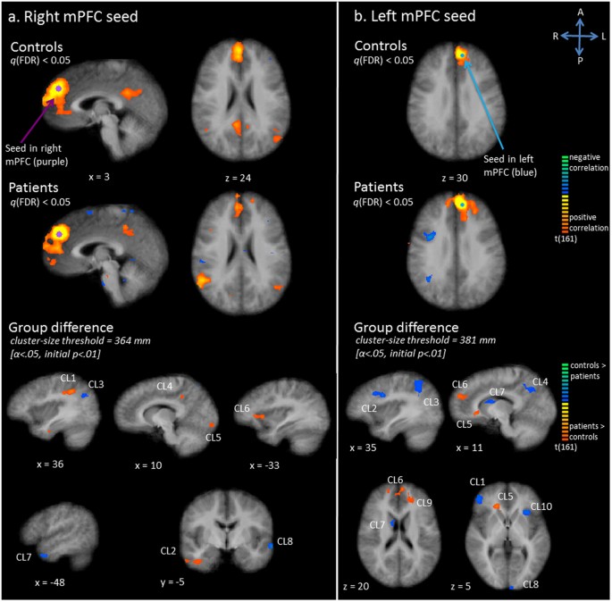 Exploration Of The Brain In Rest Resting State Functional Mri Abnormalities In Patients With Classic Galactosemia Scientific Reports