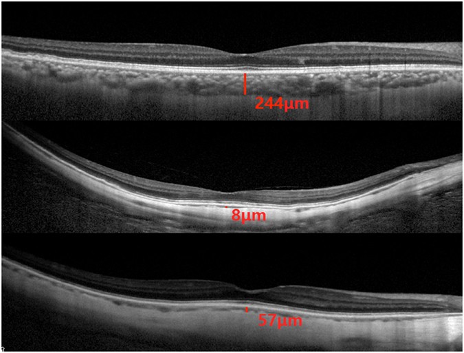 Cross Sectional Imaging Of The Choroid Using Enhanced Depth Optical Coherence Tomography OCT Subfoveal Choroidal Thickness Was Defined As Cross Sectional Imaging Of The Choroid Using Enhanced Depth Optical Coherence Tomography OCT Subfoveal Choroidal Thickness Was Defined As