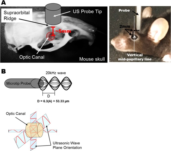 A Novel Mouse Model of Traumatic Optic Neuropathy Using External Ultrasound  Energy to Achieve Focal, Indirect Optic Nerve Injury | Scientific Reports