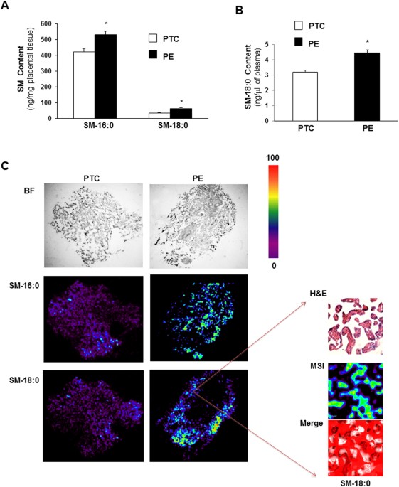 A Single Sphingomyelin Species Promotes Exosomal Release Of Endoglin Into The Maternal Circulation In Preeclampsia Scientific Reports