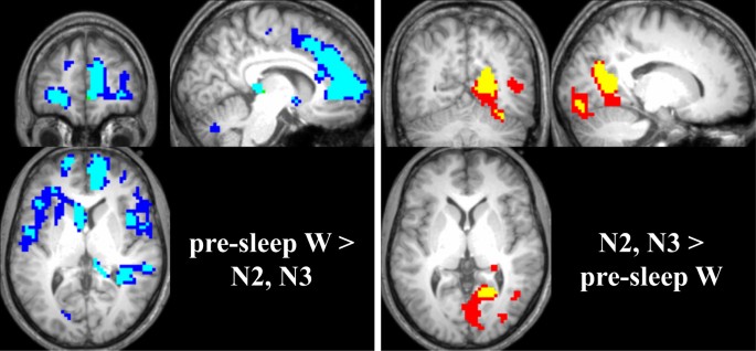 In human non-REM sleep, more slow-wave activity leads to less blood flow in  the prefrontal cortex