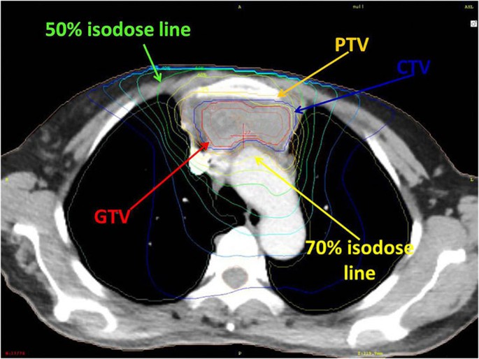 Prospective Study of Stereotactic Body Radiation Therapy for Thymoma