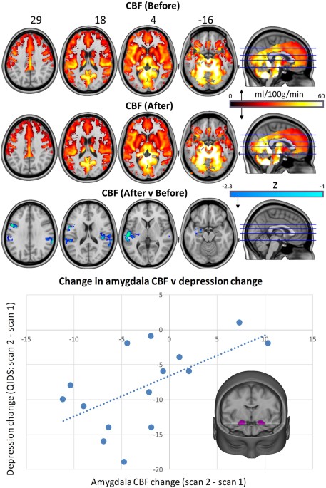 Psilocybin for treatment-resistant depression: fMRI ... brain diagram amygdala 
