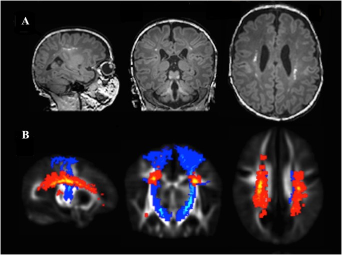 Common Cerebral White Matter >> Punctate White Matter Lesions Associated With Altered Brain Common Cerebral White Matter >> Punctate White Matter Lesions Associated With Altered Brain