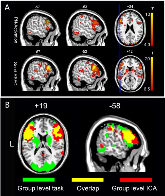 An Automated Method For Identifying An Independent Component Analysis Based Language Related Resting State Network In Brain Tumor Subjects For Surgical Planning Scientific Reports An Automated Method For Identifying An Independent Component Analysis Based Language Related Resting State Network In Brain Tumor Subjects For Surgical Planning Scientific Reports