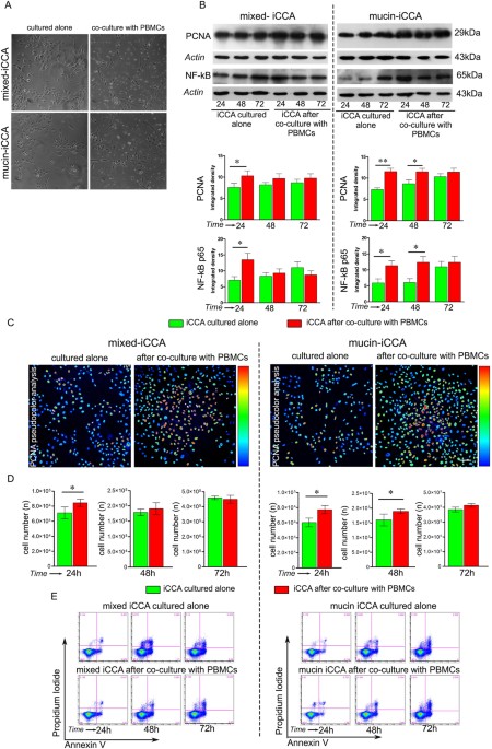 cholangiocarcinoma, Activation of Fas/FasL pathway and the role of c-FLIP in primary culture of human cholangiocarcinoma cells