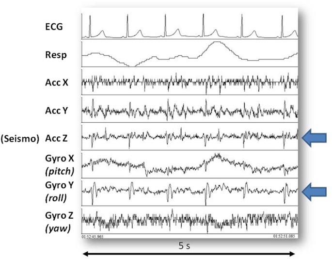 An algorithm for the beattobeat assessment of cardiac mechanics