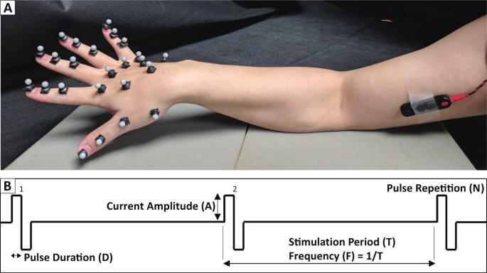 Upper/Outer Forearm Electrode Pad Placement  Extensors of Wrist & Fingers  Electrode Images/Video