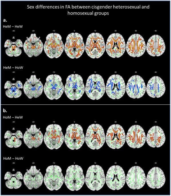 Structural connections in the brain in relation to gender identity and  sexual orientation | Scientific Reports