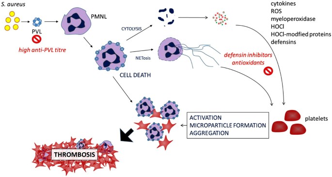 Panton-Valentine Leukocidin associated with S. aureus osteomyelitis  activates platelets via neutrophil secretion products | Scientific Reports