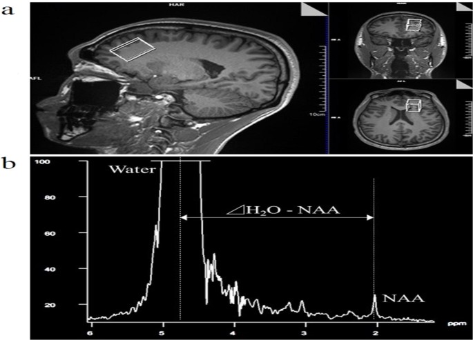 Ice slurry ingestion reduces human brain temperature measured using non-invasive magnetic resonance spectroscopy
