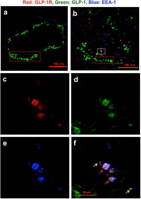 glp-1 pancreatitis class action in louisiana GLP-1 Agonists and Pancreatitis Risk