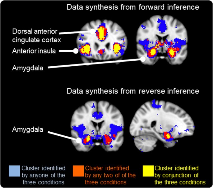 brain scan visualization showing anxiety centers activated during public speaking with highlighted amygdala