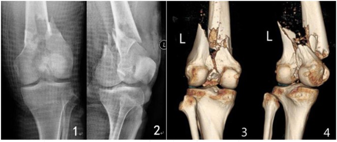 Fractures of Posterior Process of Talus