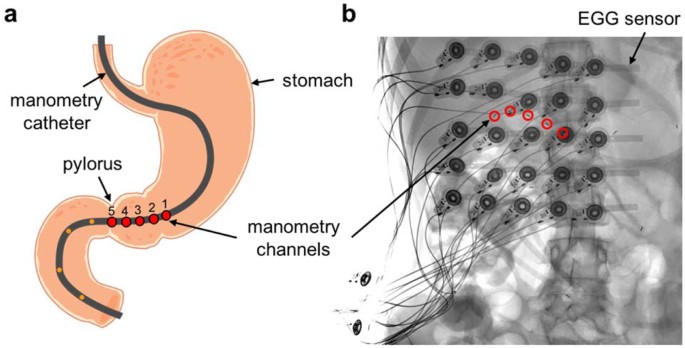 Gastrointestinal Myoelectrical Activity in Idiopathic Intestinal  Pseudo-Obstruction