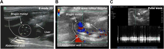 Validation of ultrasound bioimaging to predict worm burden and 