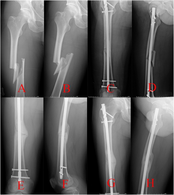 JBJS: Atypical Femoral Fracture Despite Prophylactic Intramedullary Nailing