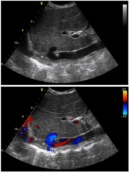 Long term Outcome Of Recoverable Stents For Budd Chiari Syndrome Complicated With Inferior Vena 