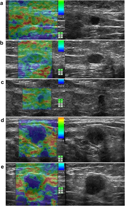 Application of Real-time Elastography Ultrasound in the Diagnosis