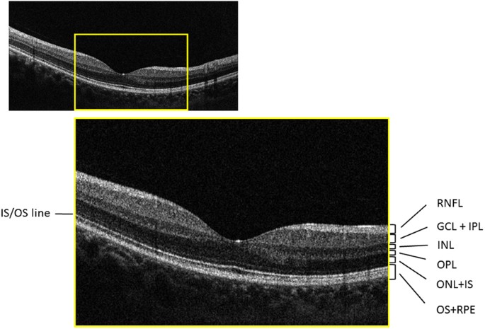 Layers of the Retina - Discovery Eye Foundation