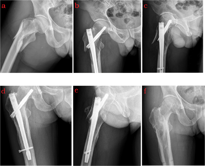 Z-effect after intramedullary nailing systems for trochanteric femur  fractures | Semantic Scholar