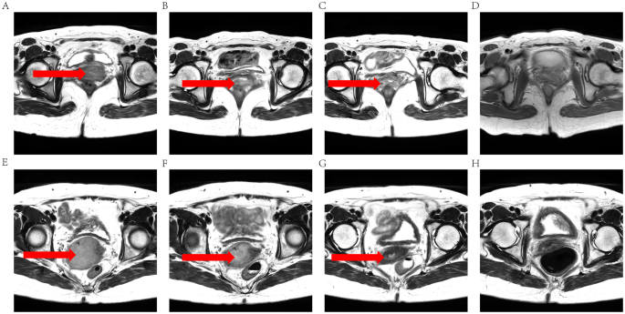 Texture Analysis as Imaging Biomarker for recurrence in advanced cervical  cancer treated with CCRT | Scientific Reports