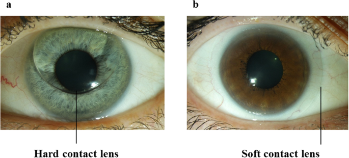 Proteomics Unravels the Regulatory Mechanisms in Human Tears Following  Acute Renouncement of Contact Lens Use: A Comparison between Hard and Soft  Lenses | Scientific Reports