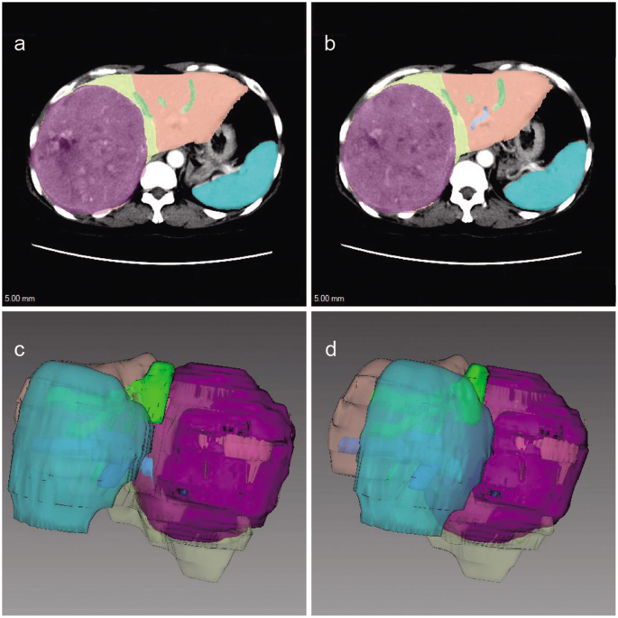 A novel, non-invasive model for diagnosing liver fibrosis stage in patients with hepatocellular carcinoma