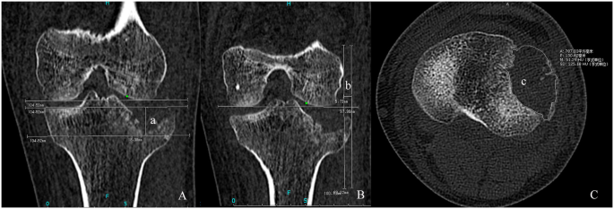 Incidence And Radiological Predictors Of Concomitant