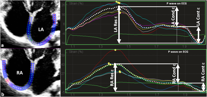 PDF] Normal values and clinical relevance of left atrial myocardial  function analysed by speckle-tracking echocardiography: multicentre study.