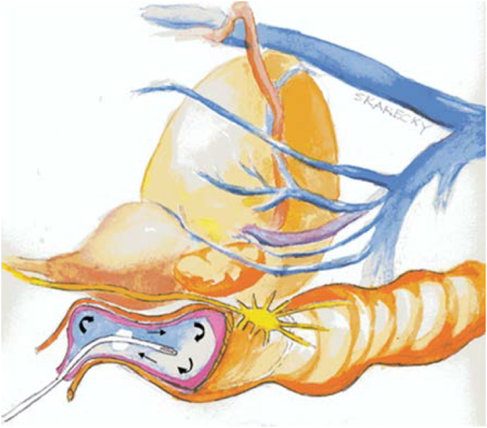 A Randomized Control Trial Of Anti-Inflammatory Regional Hypothermia On  Urinary Continence During Robot-Assisted Radical Prostatectomy | Scientific  Reports