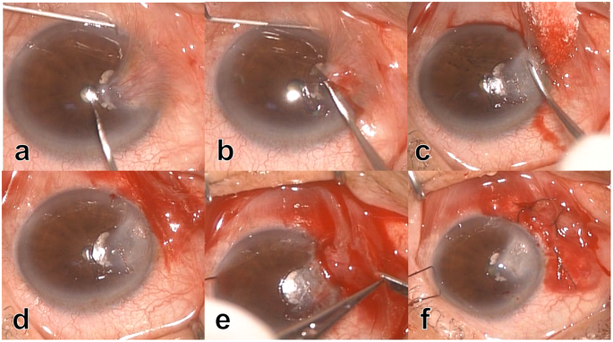 Head inversion technique to restore physiological conjunctival structure for surgical treatment of primary pterygium | Scientific Reports Head inversion technique to restore physiological conjunctival structure for surgical treatment of primary pterygium | Scientific Reports