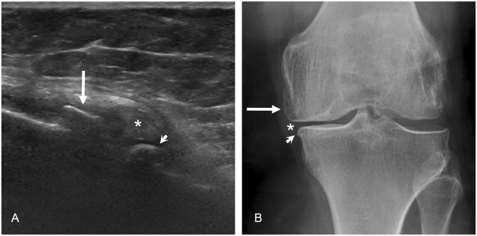 Ultrasonography Of The Late Stage Knee Osteoarthritis Prior To Total