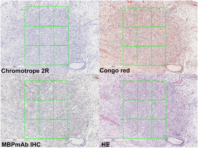 Comparison of four staining methods for detecting eosinophils in nasal polyps