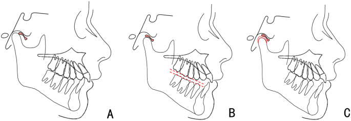 Essential requirements of a non-occlusal mandibu- lar reference