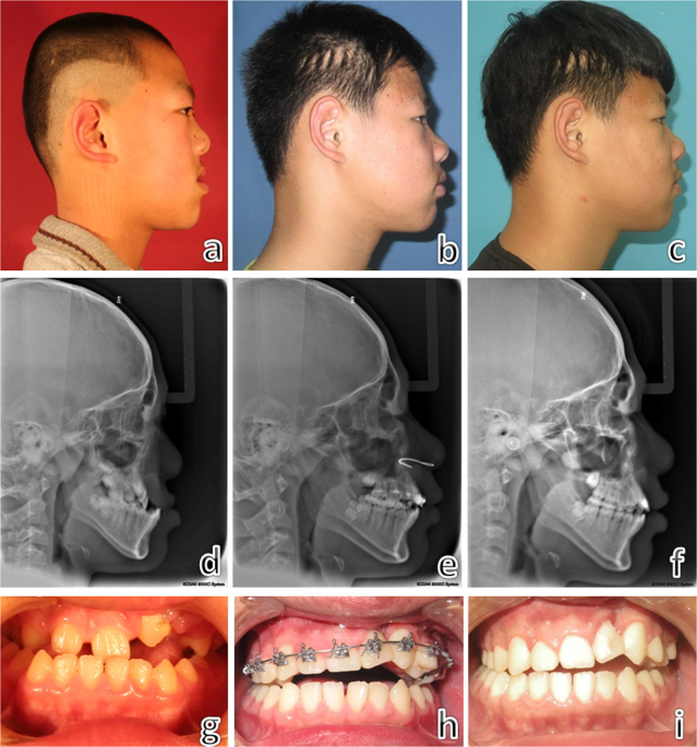 Imaging study of midface growth with boneborne transsutural
