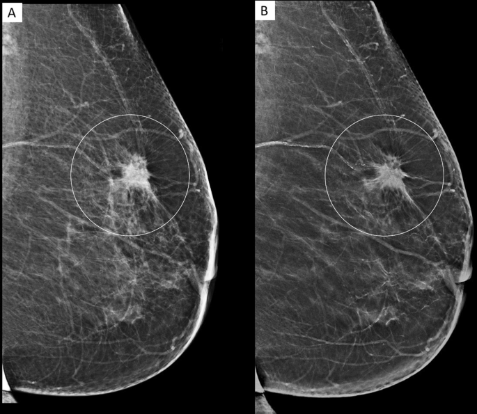 Tomosynthesis definition picture