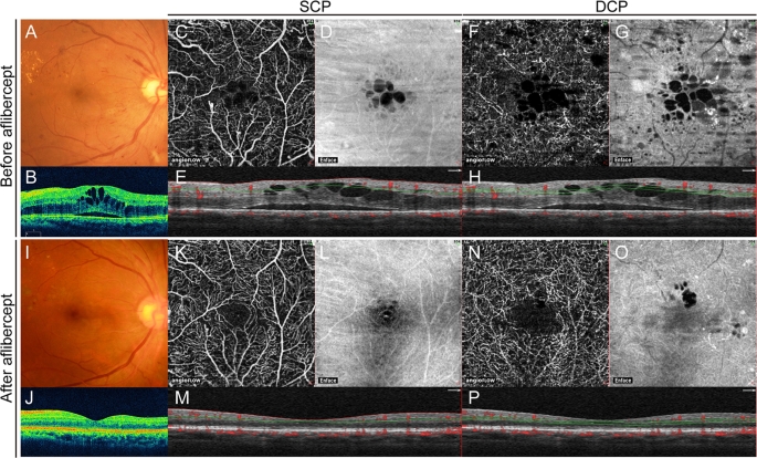 Retinal Microvasculature And Visual Acuity After Intravitreal Aflibercept In Diabetic Macular Edema An Optical Coherence Tomography Angiography Study Scientific Reports