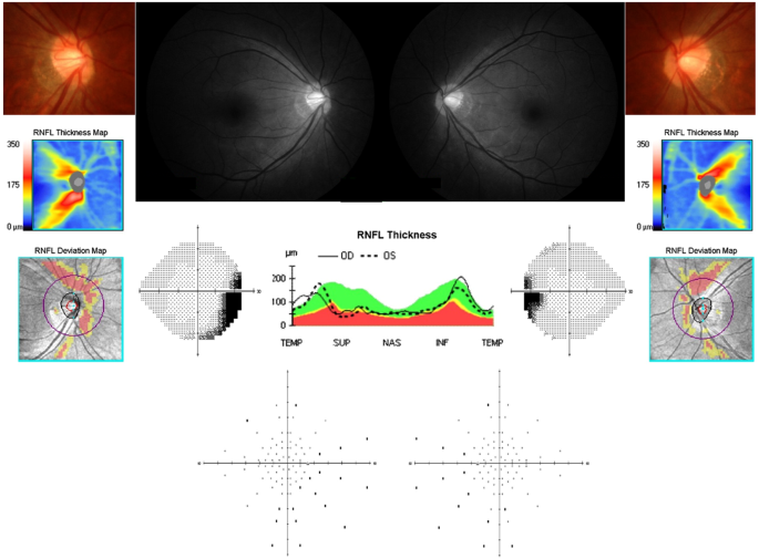 Vertical disc tilt and features of the optic nerve head anatomy are